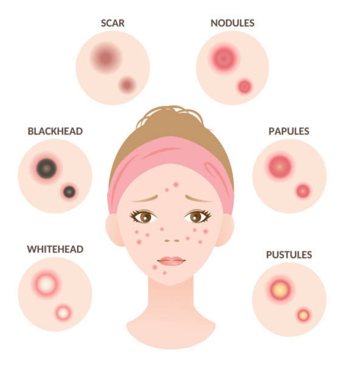top-home-remedies-for-acne-on-the-planet
