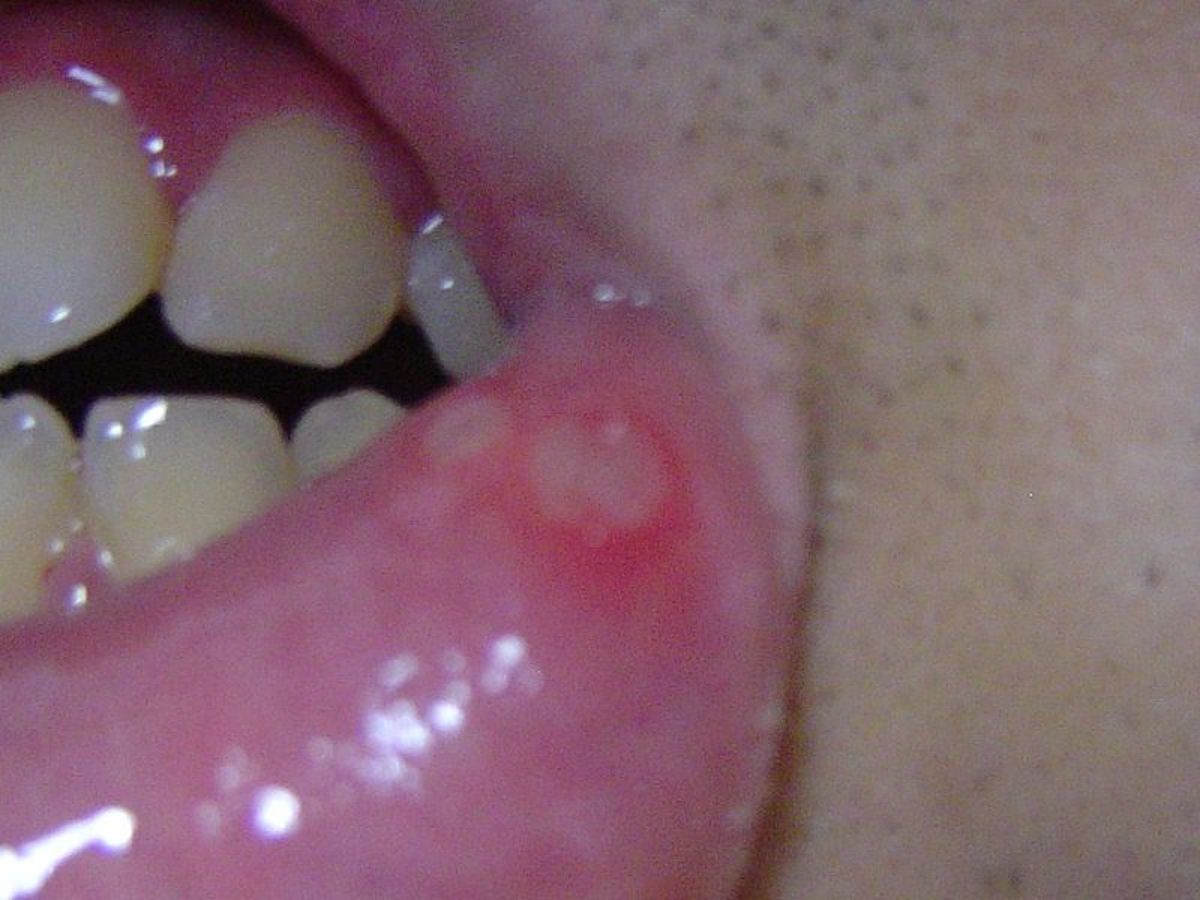 Eurgh, nasty! Make sure to maintain your mouth's natural pH levels with proper hygiene in order to prevent canker sores like this.