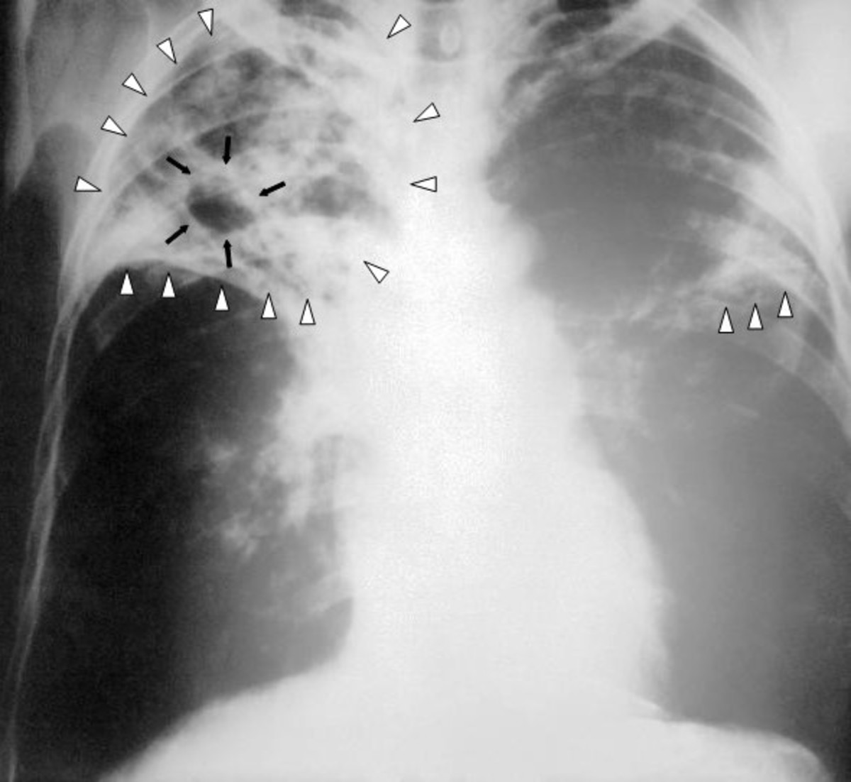 Lungs shows TB