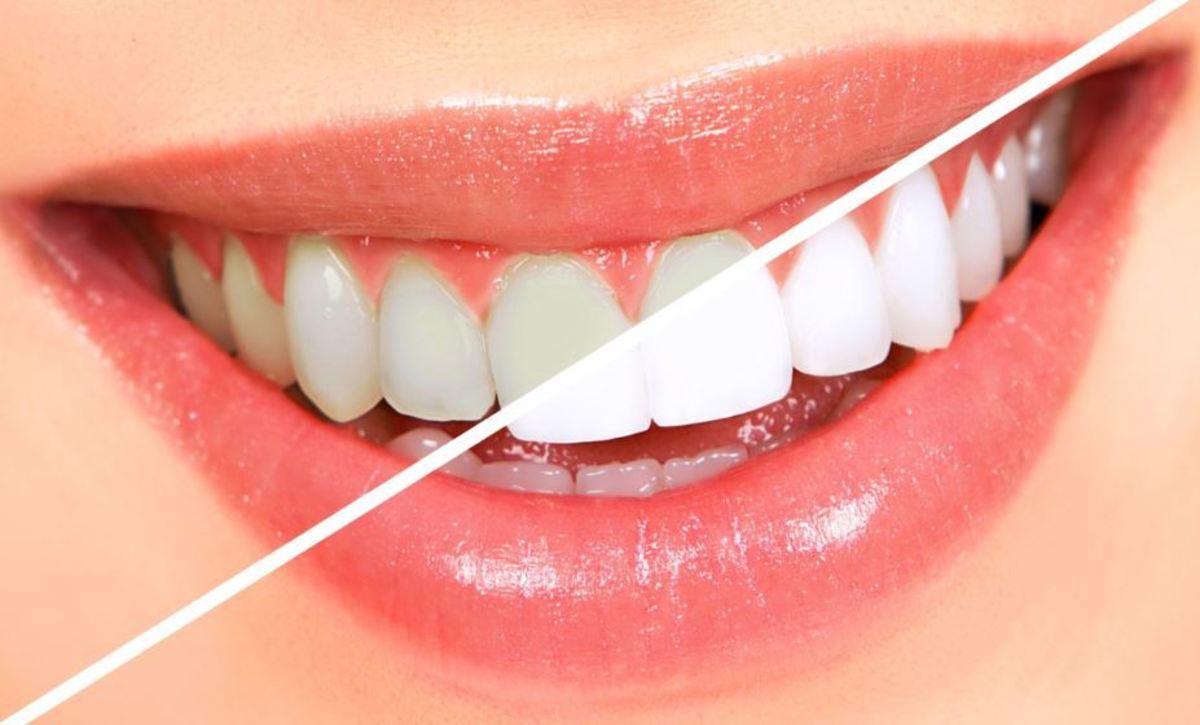 teeth-whitening-cosmetic-dentistry-techniques
