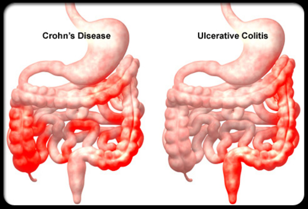 Cohen's Disease Compared to Ulcerative Colitis