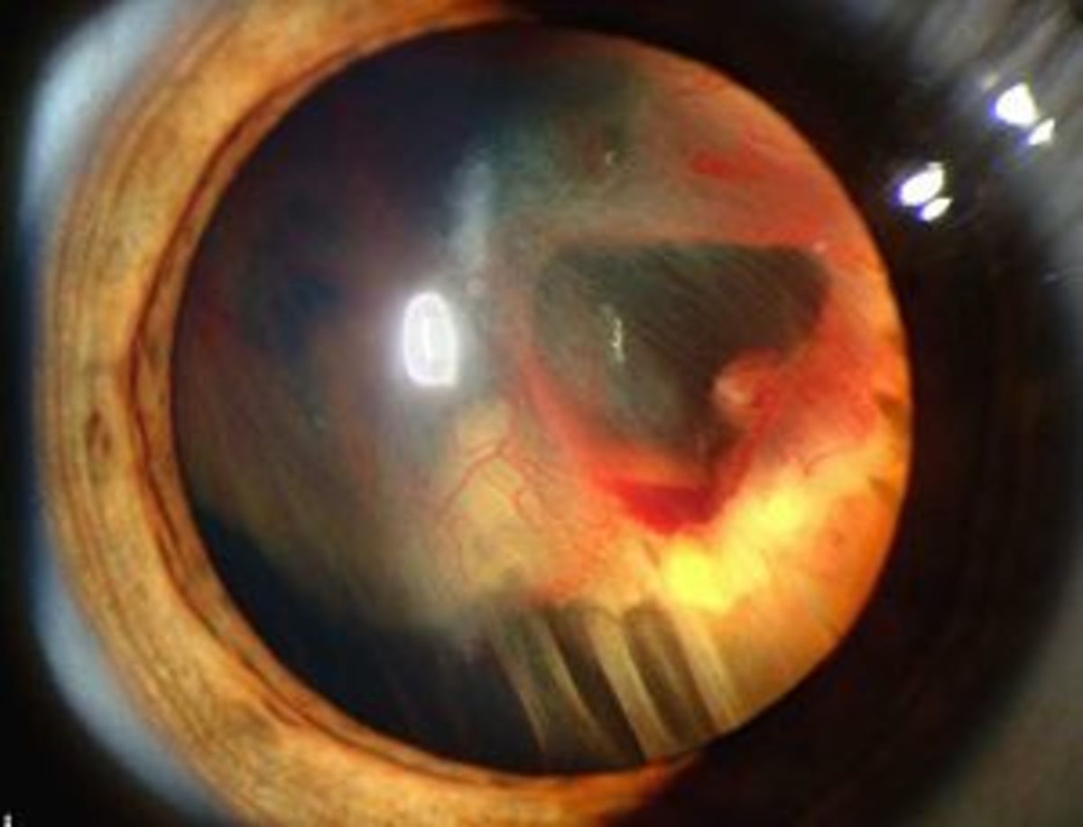 Slit lamp photograph showing retinal detachment beneath blood inside the eye