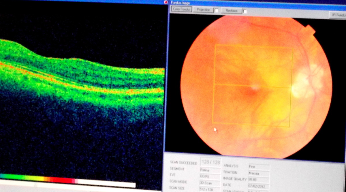 Retina OCT scan of the right eye  This Vein appears somewhat repaired. Right Eye
