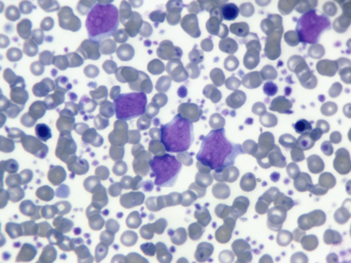 Blood Smear of Acute Myeloid Leukemia