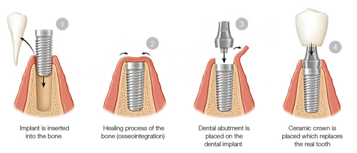 the-advent-of-the-dental-implant