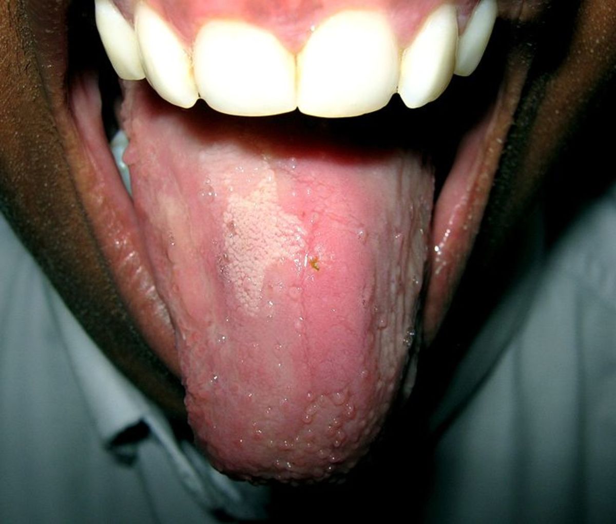 Inflamed tongue