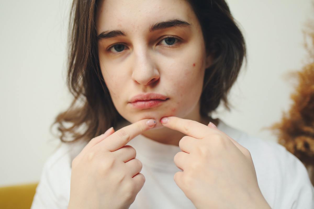Acne and pimples are the first sign of the onset of puberty