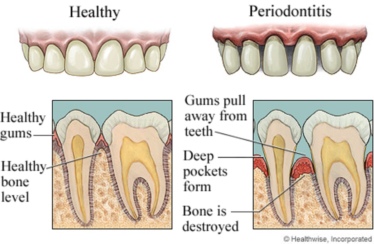 Why do My Gums Bleed? - HubPages, image size:1200x783