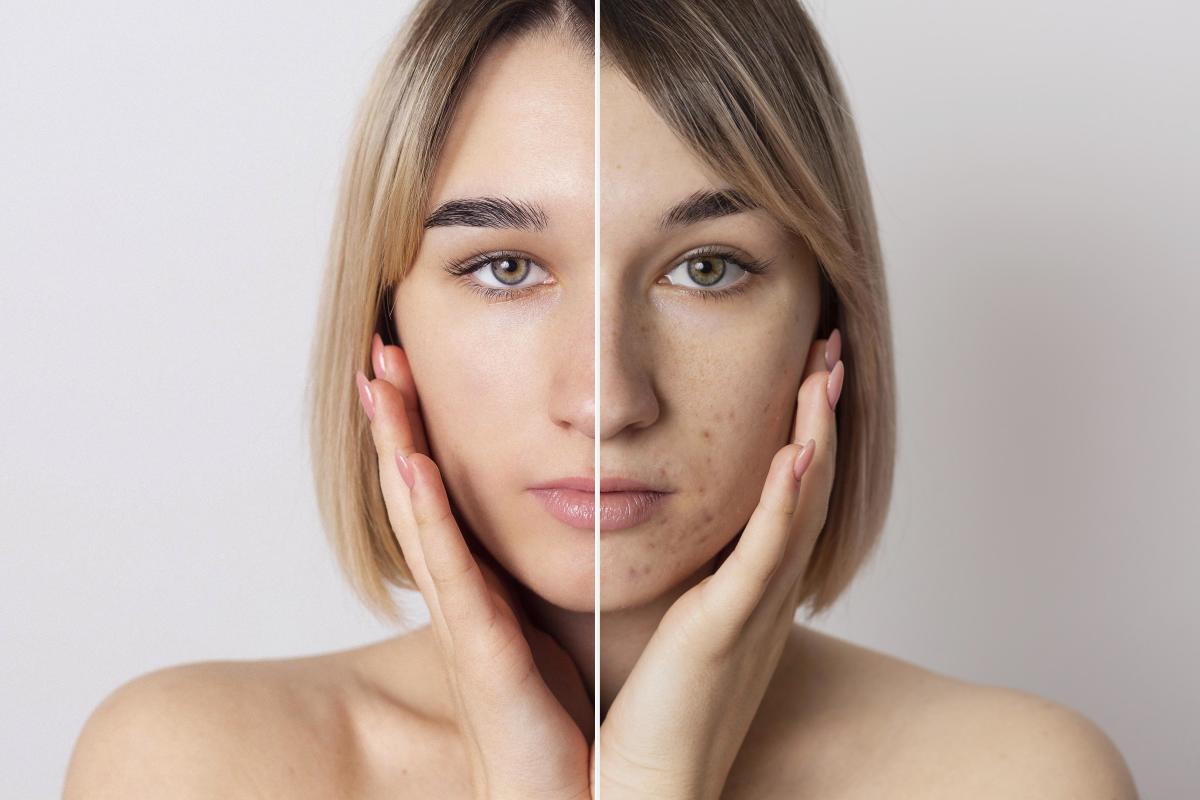 The Effect of Winter on the Skin