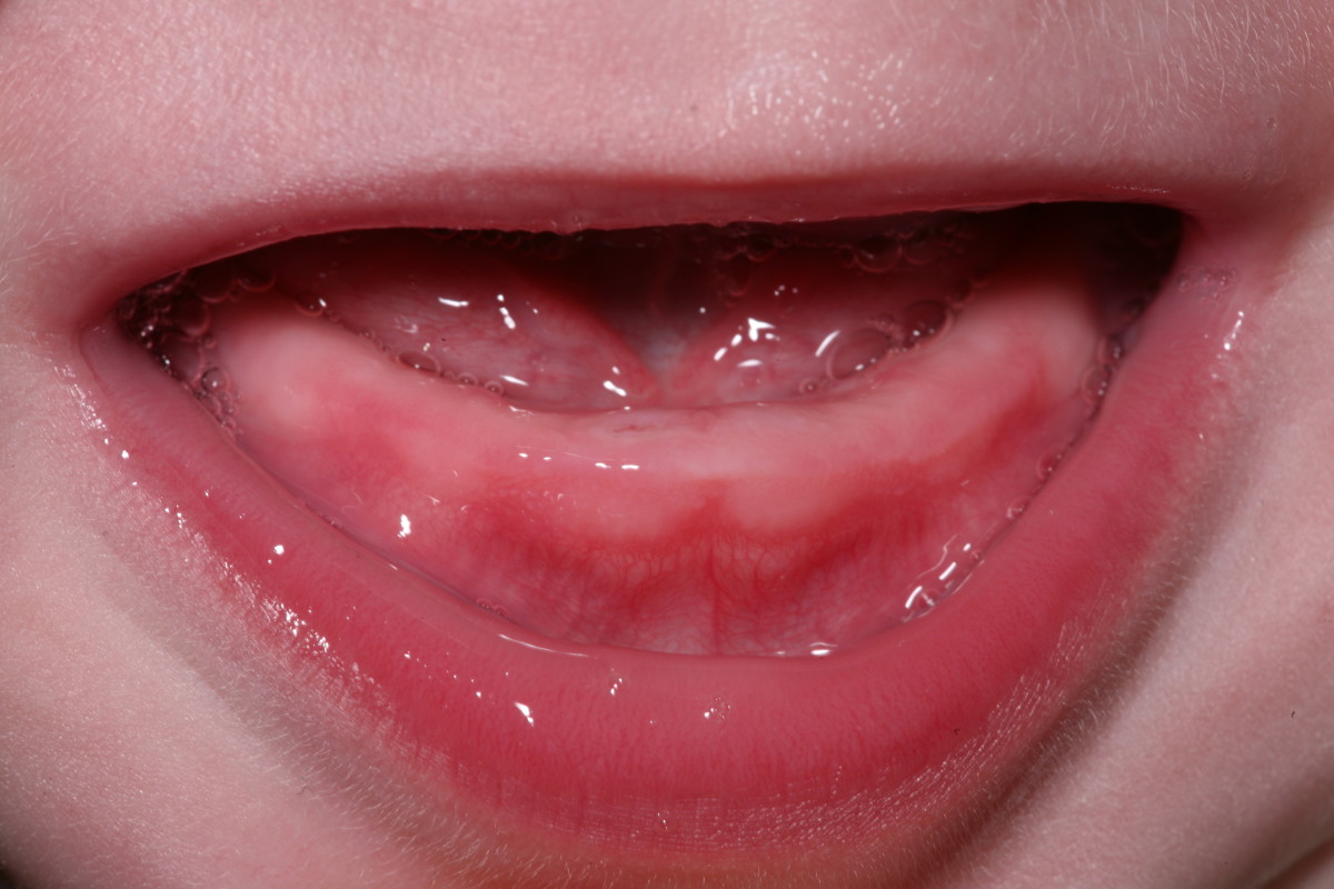 A 9-month-old infant with a right lower central incisor about to emerge 