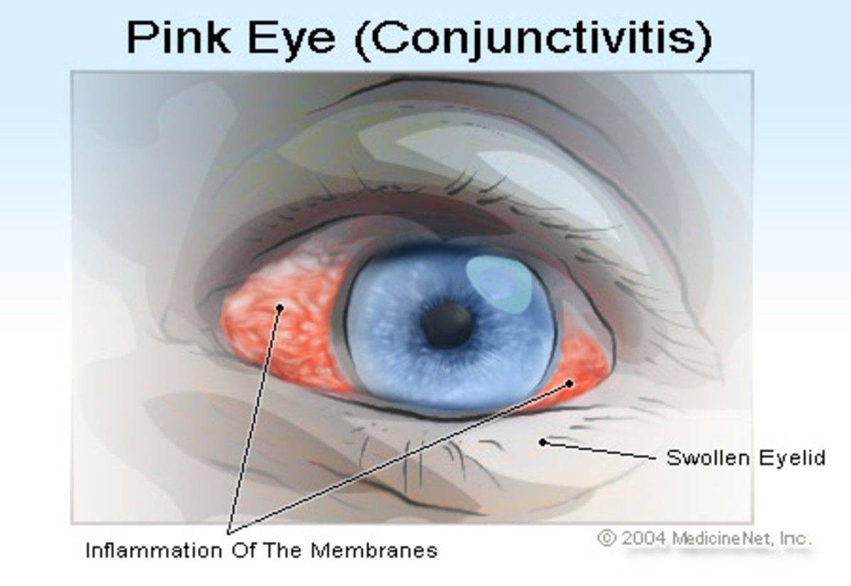 Home Remedies for Pink-Eye / Conjunctivitis