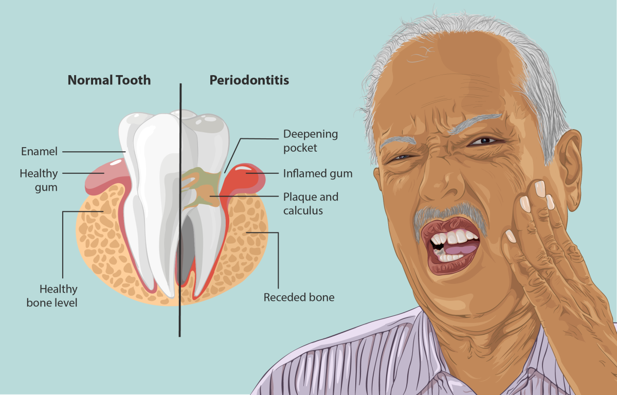 Gums peeling may be an early warning sign of gum disease