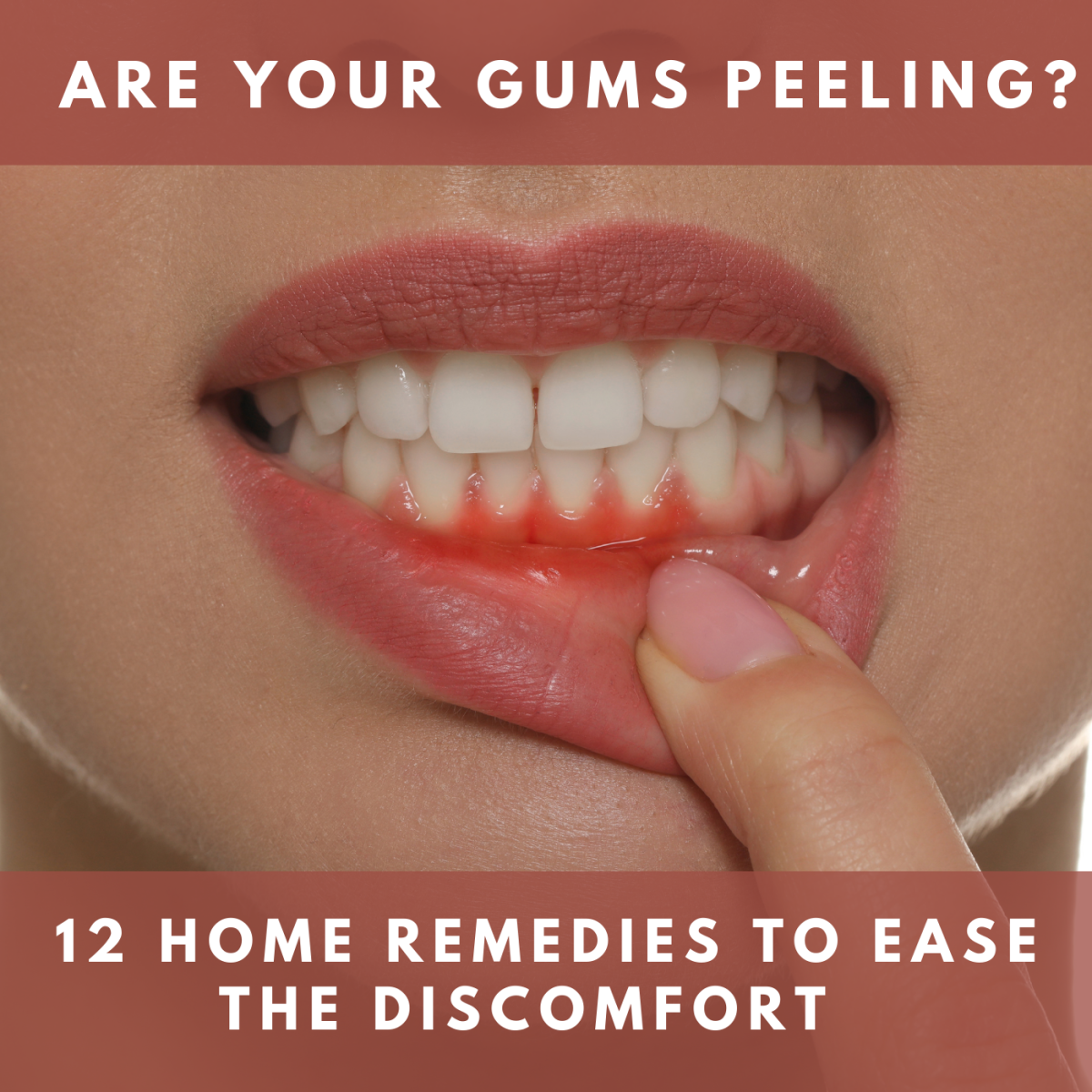 Home remedies for peeling gums