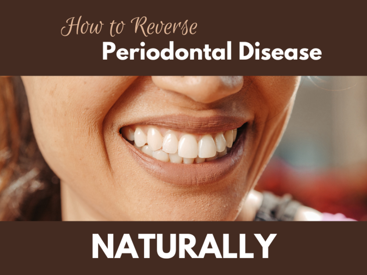 How to Reverse Periodontal Disease Naturally