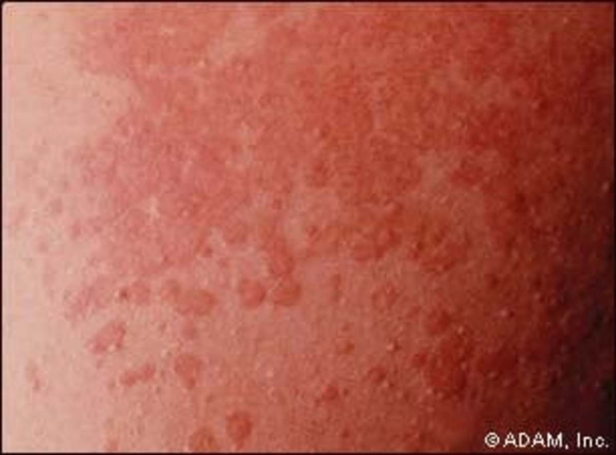 How I Treated Tinea Versicolor With Selsun Blue Patient's Lounge