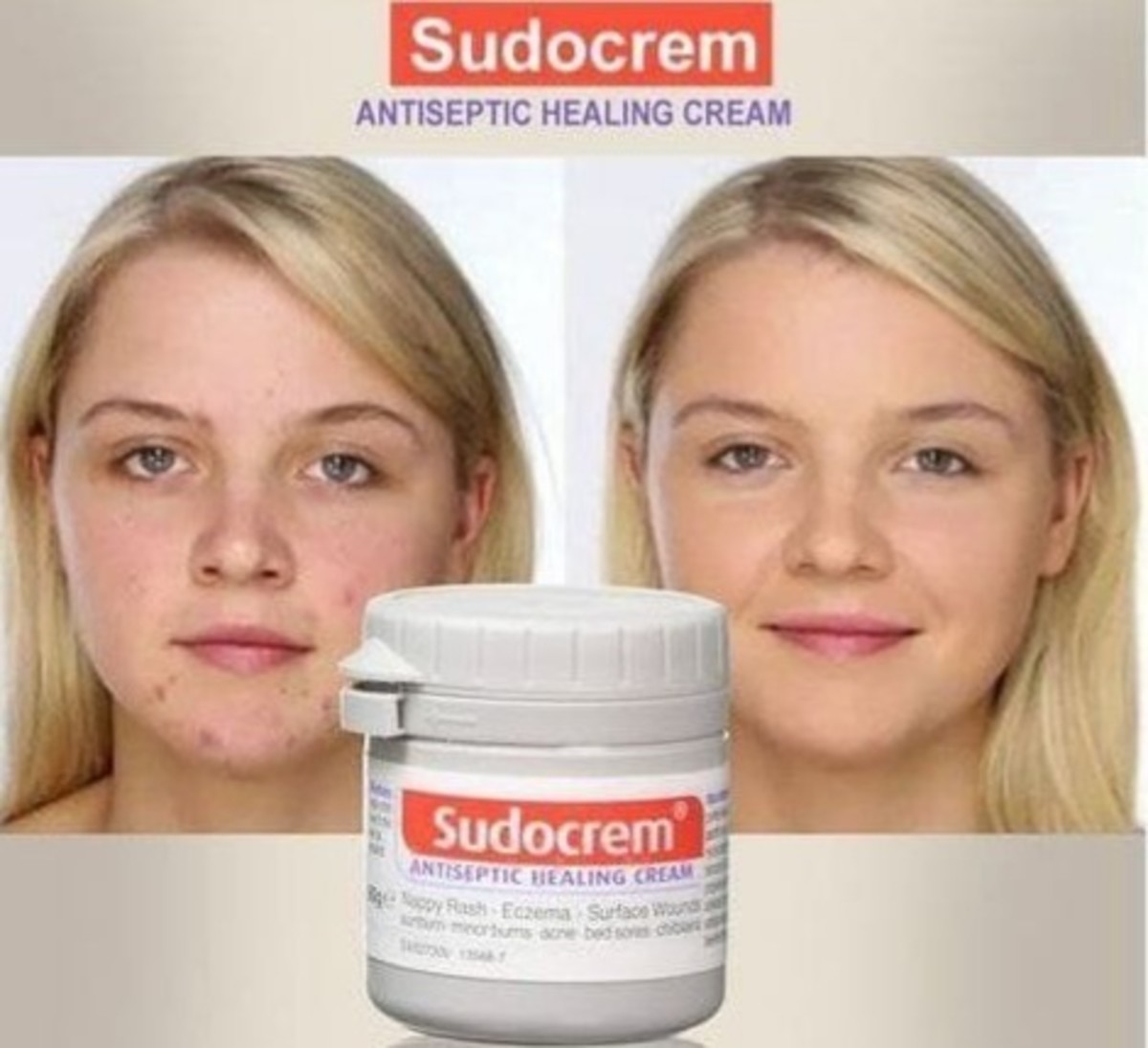 Sudocrem Uses and Benefits on Acne Prone Skin and Acne Scars