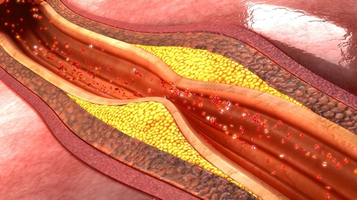 During advanced atherosclerosis, the artery lining is coated with layers of immune cells (macrophages), lipids, calcium and fibrous connective tissue—restricting blood flow downstream.
