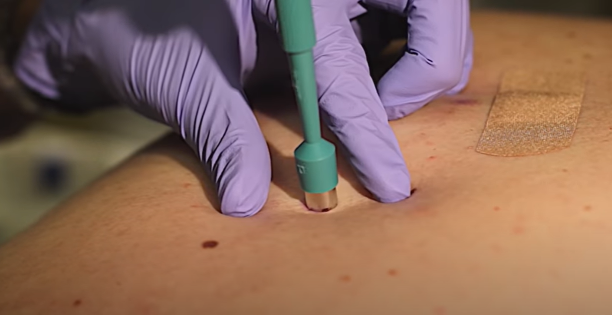 What Happens to a Biopsy After Surgery?
