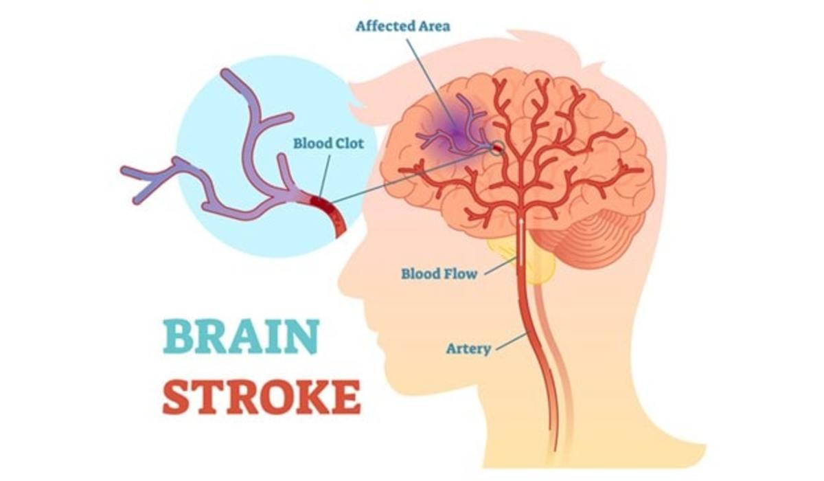 How a Stroke In The Right brain Affects The Body & How to Recover - Saebo