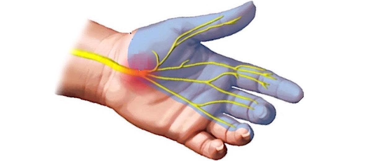 Example of How Carpal Tunnel Syndrome Can Be Misdiagnosed