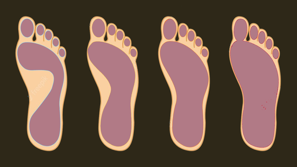 How to Fix Flat Feet (With Targeted Exercises)