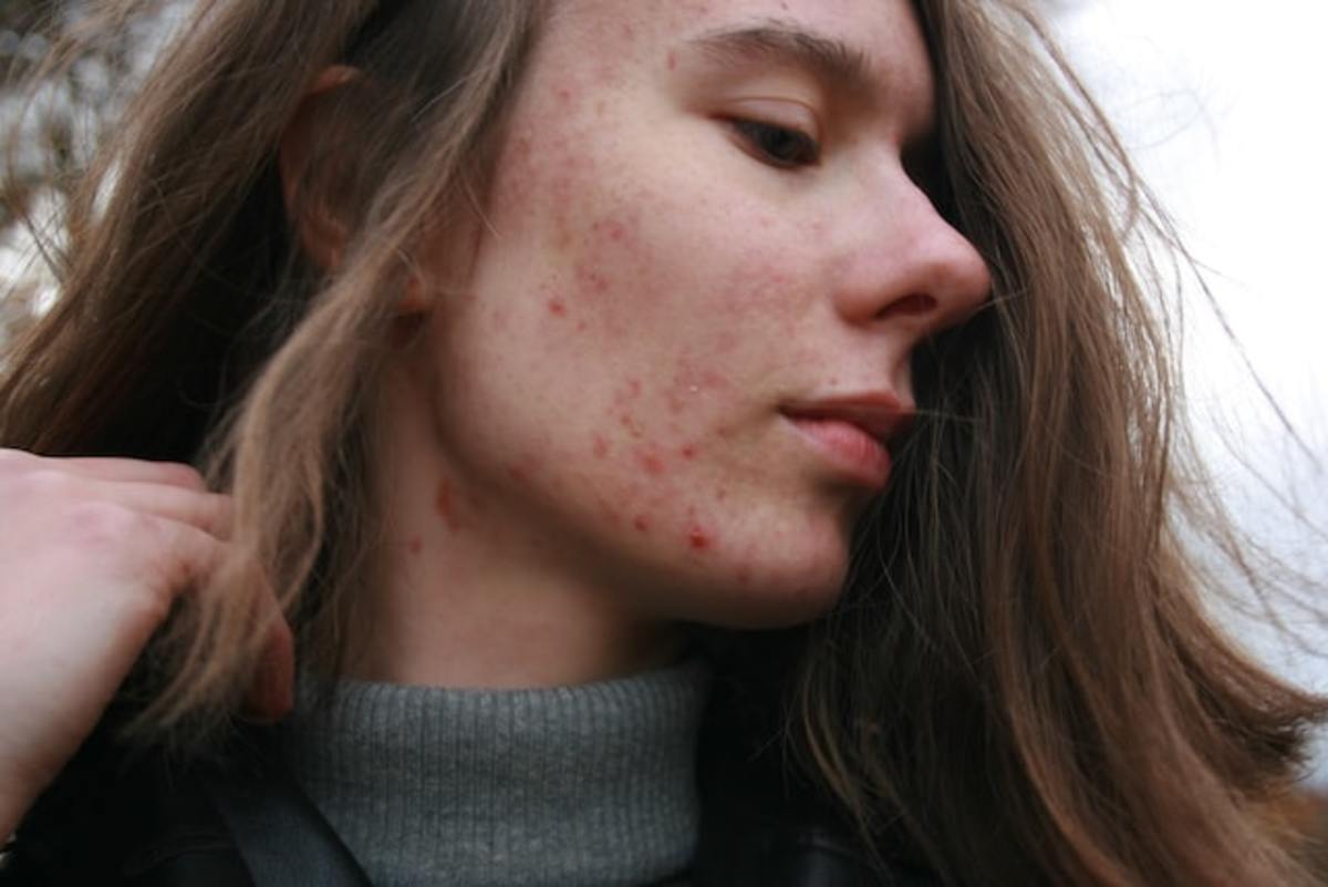 The Beginners Guide to Using CBD for Acne