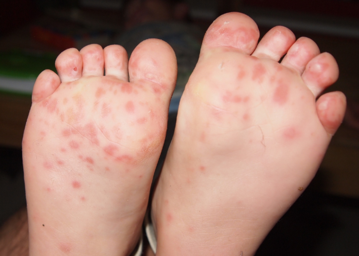 7 Possible Causes Of Red Dots On Feet YouMeMindBody