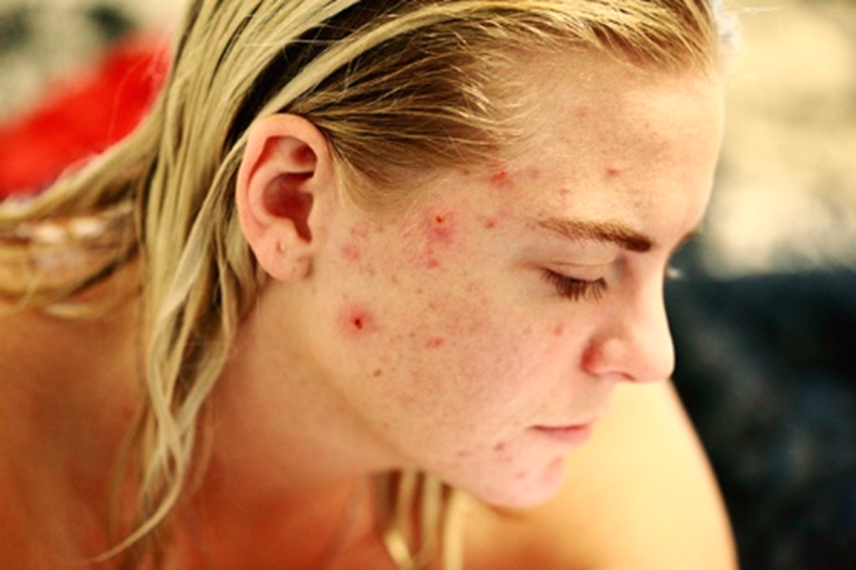Self-Help Acne Treatments to Boost Self-Esteem and Confidence