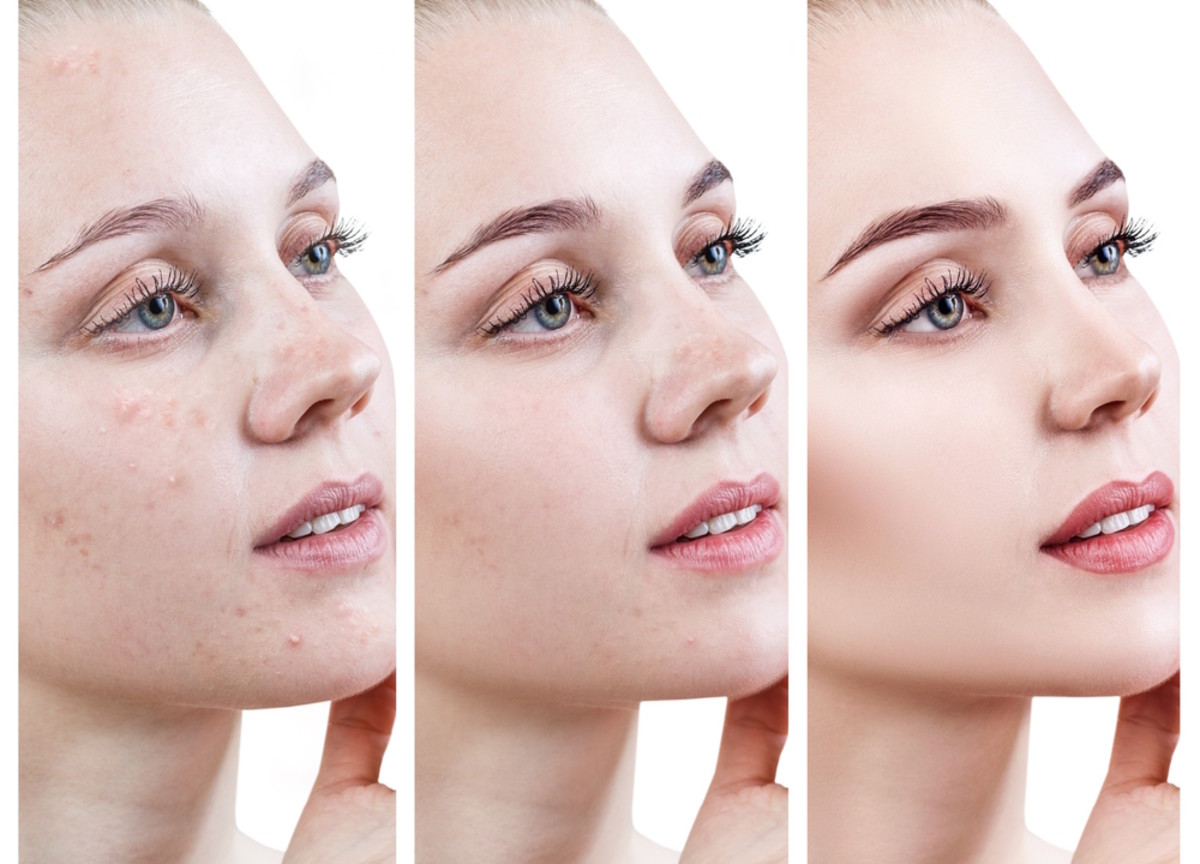 How to Use Makeup if You Have Acne-Prone Skin