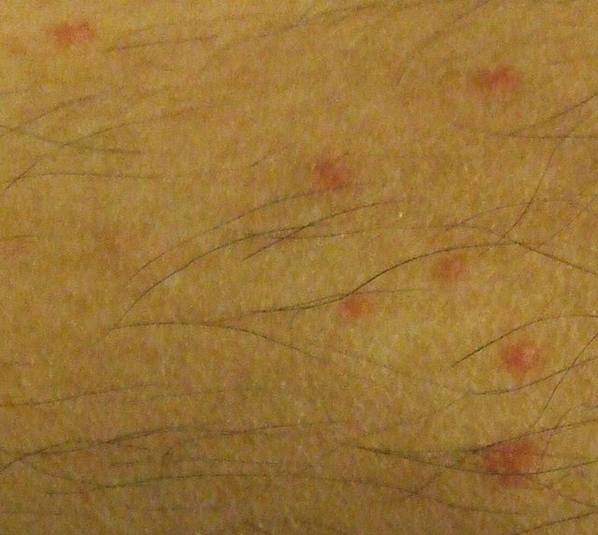 Flea Bites on Humans: Symptoms, Treatment, and More