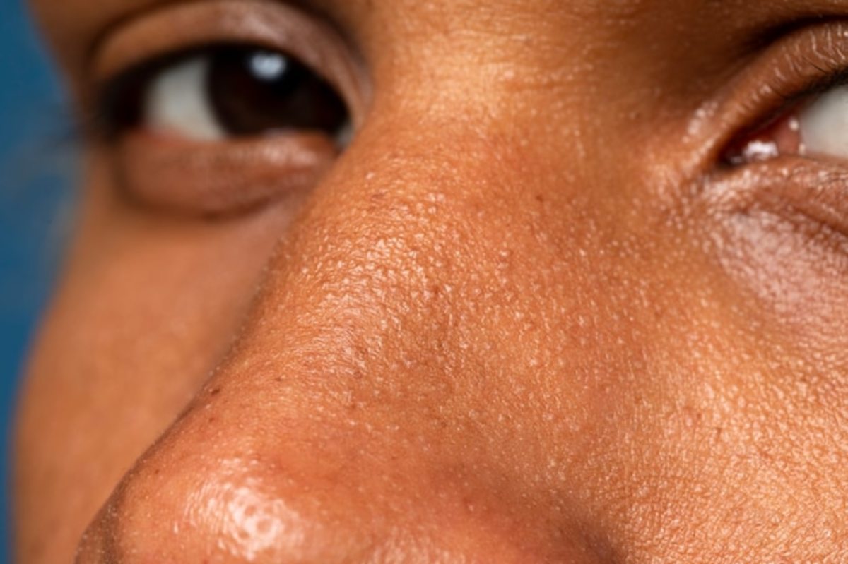 The 3 Main Challenges of Having Hyperpigmentation