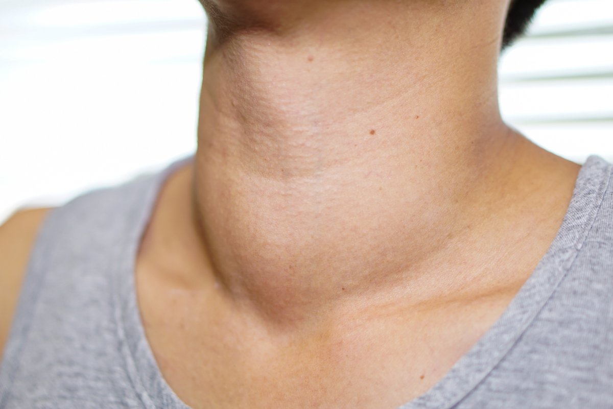 Causes and Treatments of Lumps: Neck, Armpit, Wrist, & More
