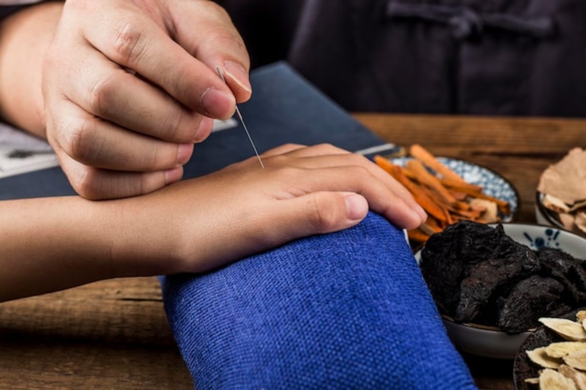 What Are The LongTerm Benefits of Acupuncture? HubPages