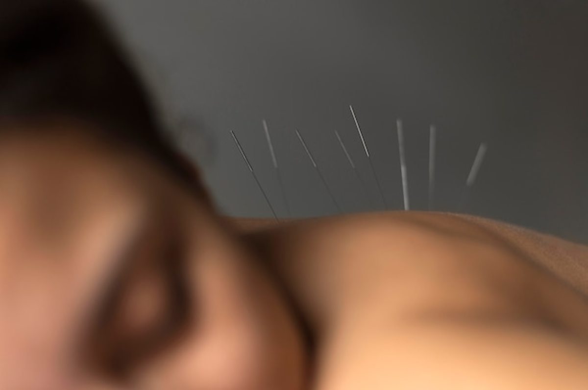 What Are The Long-Term Benefits of Acupuncture?