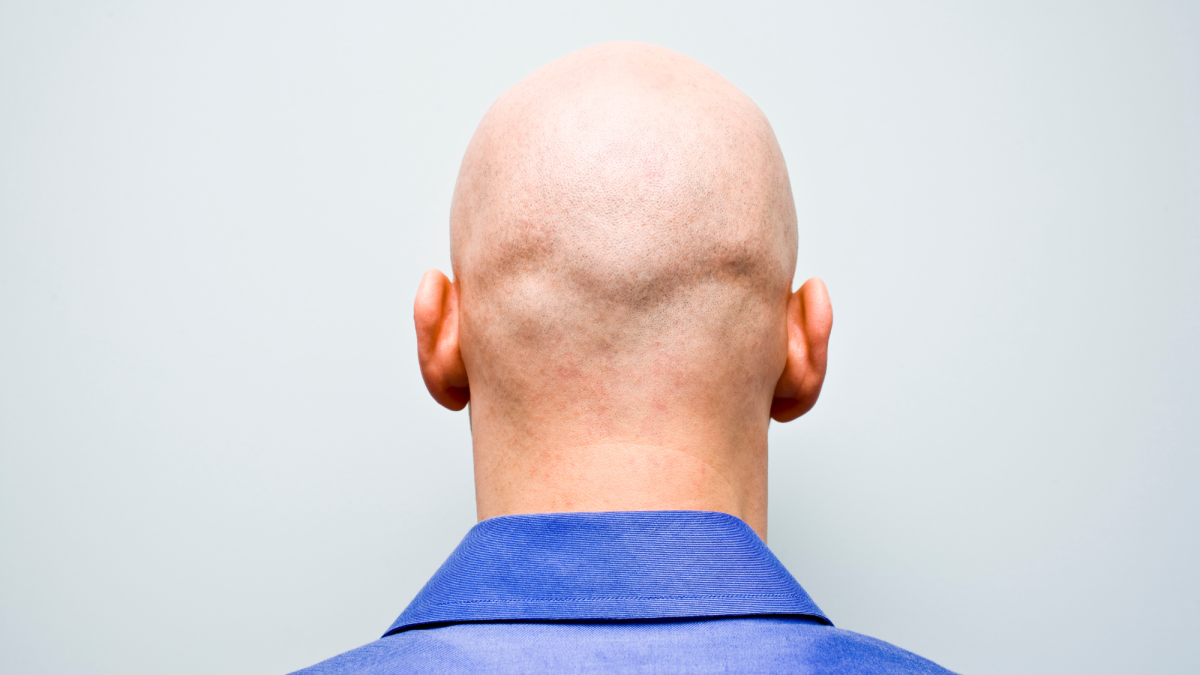 Do Women Find Bald Men Attractive?