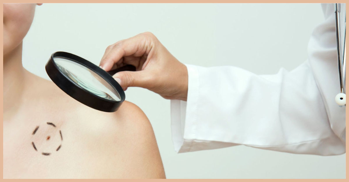 Facts About Melanoma Skin Cancer