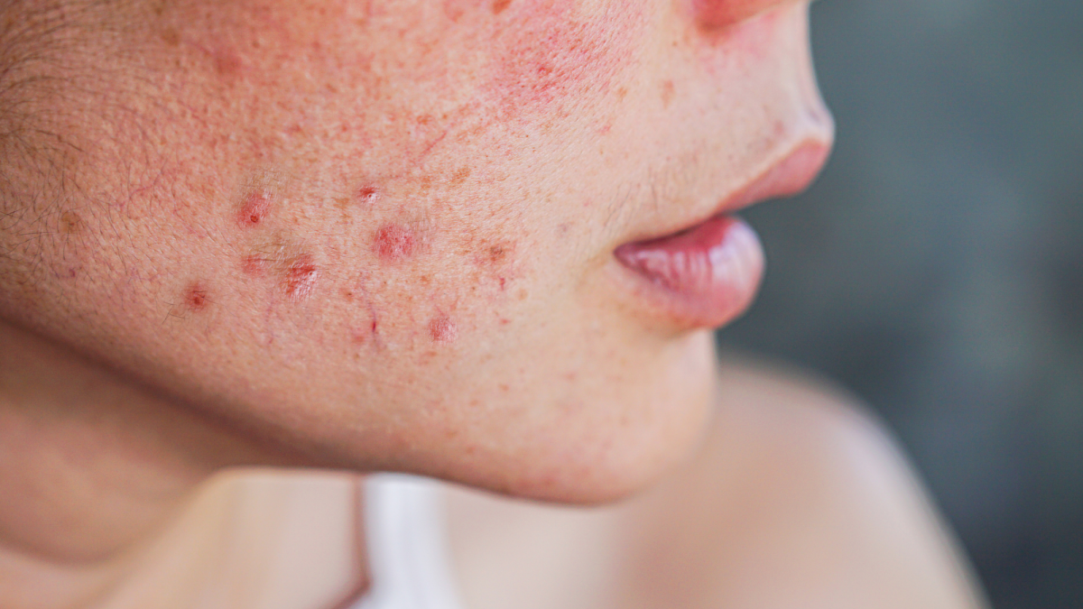 How to Prevent Spots and Pimples With Easy Hygiene Tips