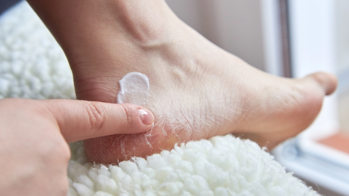 How to Heal Cracked Feet and Dry Heels With Essential Oils