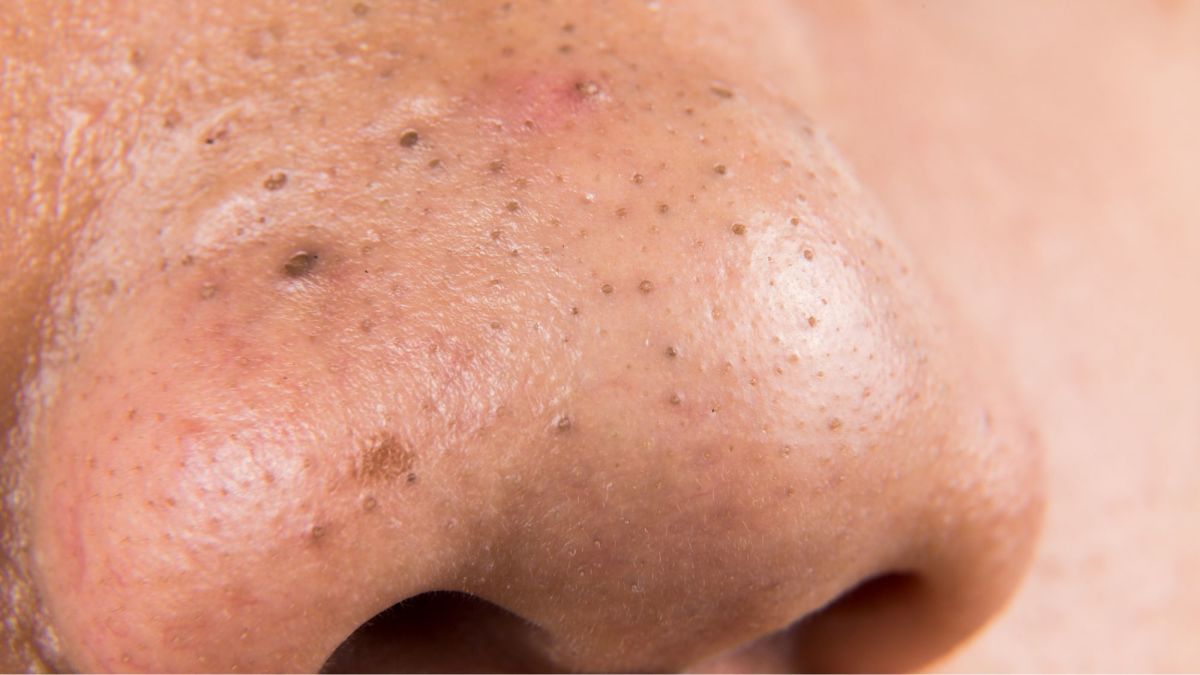 6 Homemade Recipes to Get Rid of Blackheads