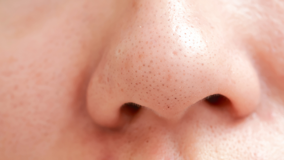 Get Rid of Blackheads on Your Nose With These Easy Tips