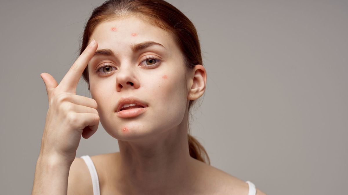 How to Treat Young, Oily, Acne-Prone Skin