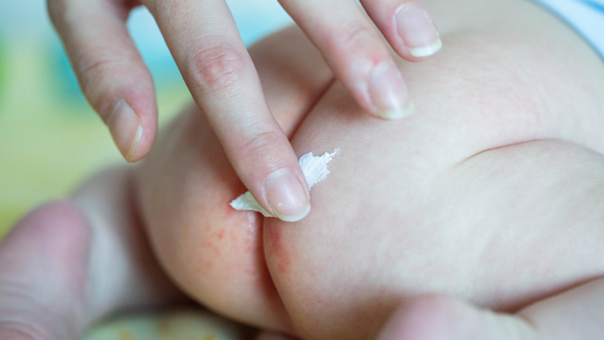 Triple Paste: Only Diaper Rash Cream That Worked for My Newborn