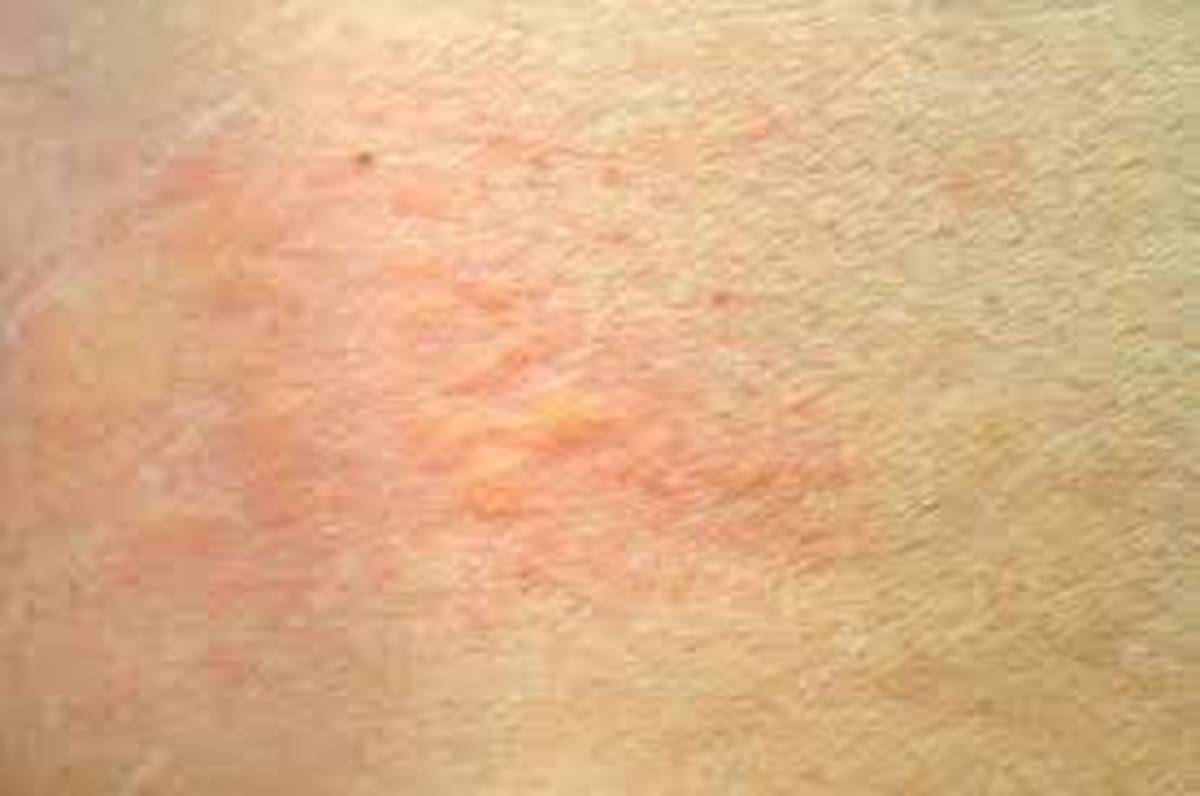 The Association Between Urticaria (Hives), High Blood Pressure and Magnesium