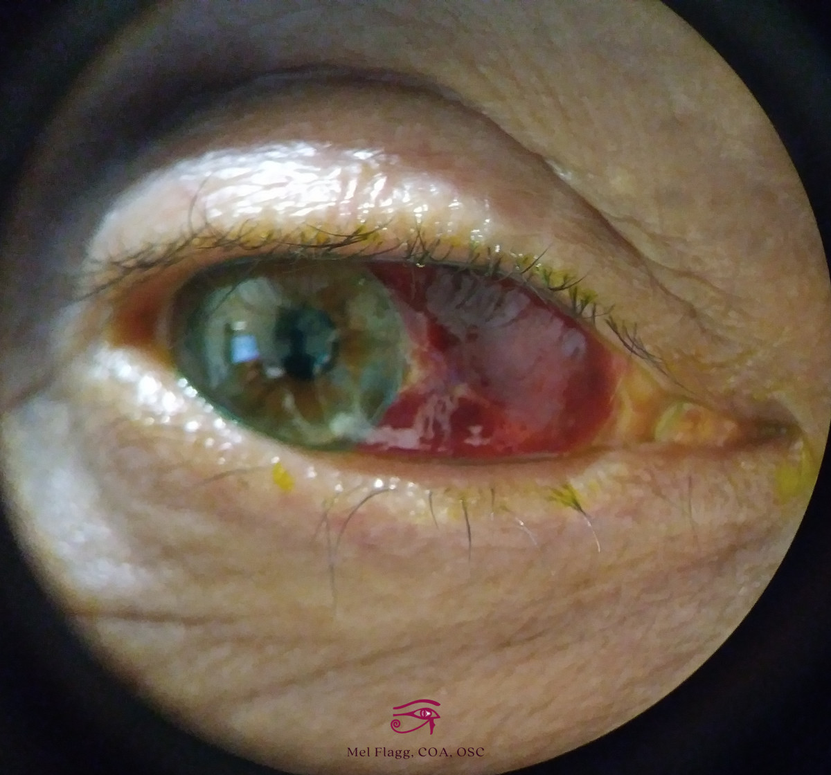 Subconjunctival Hemorrhage: Broken Blood Vessel in the Eye