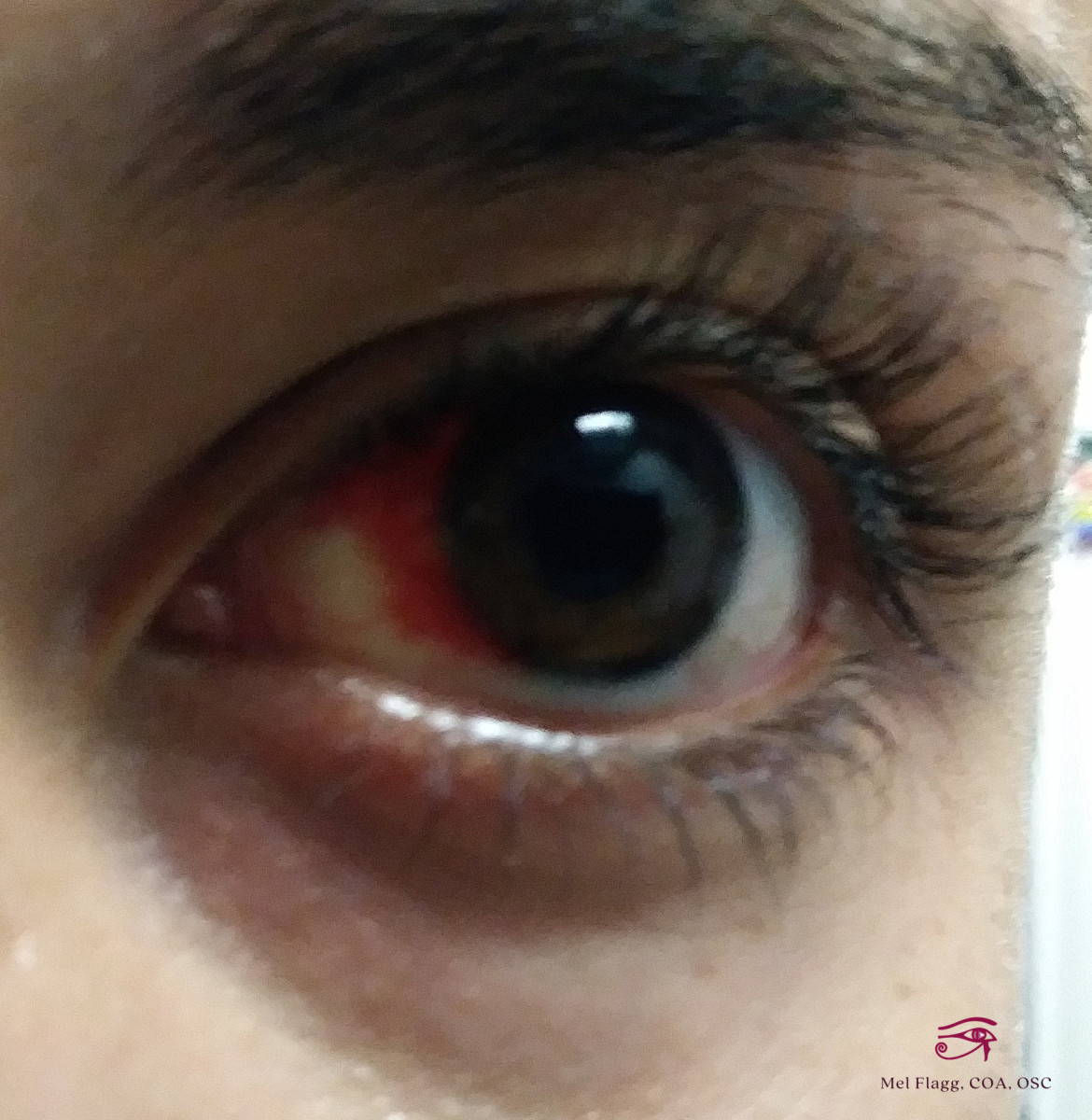 Subconjunctival Hemorrhage: Broken Blood Vessel in the Eye - YouMeMindBody