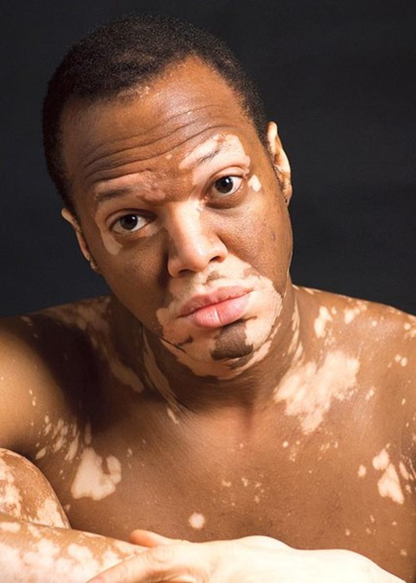 vitiligo-understanding-the-misunderstood-symptoms-diagnosis-relief-treatment