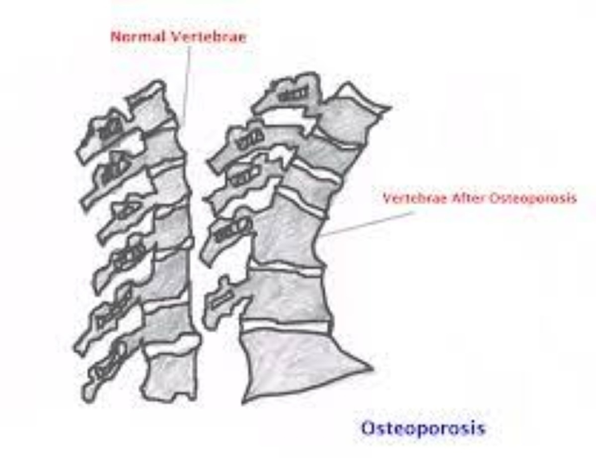 is-osteoporosis-genetic-the-risks-the-factors-and-what-you-can-do