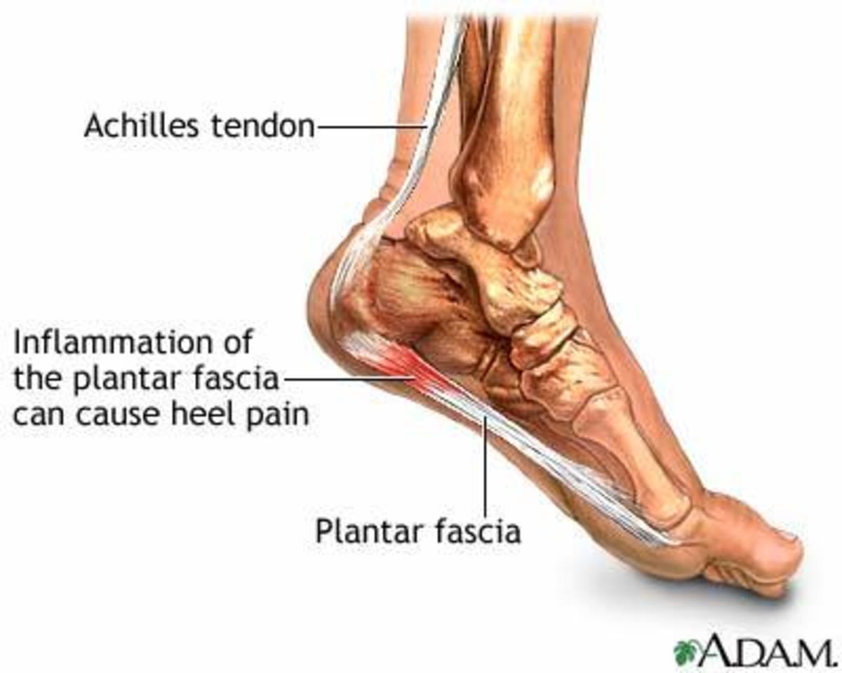 Relief for Plantar Fasciitis Without Doctors (Updated)