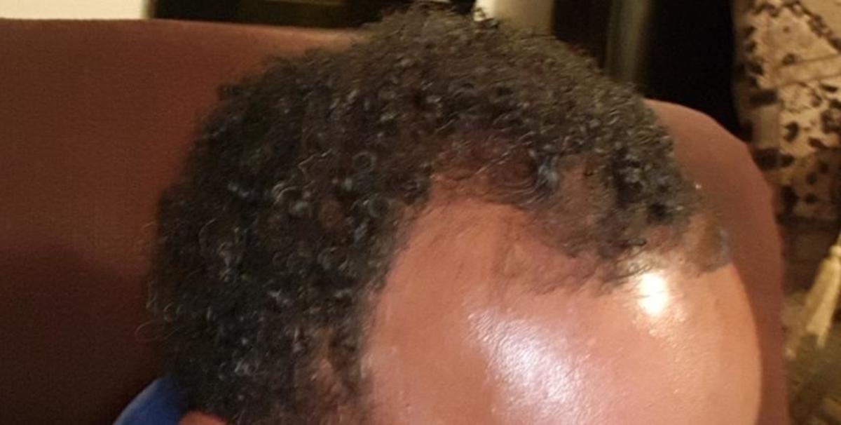 male, receding hairline, 30 years old