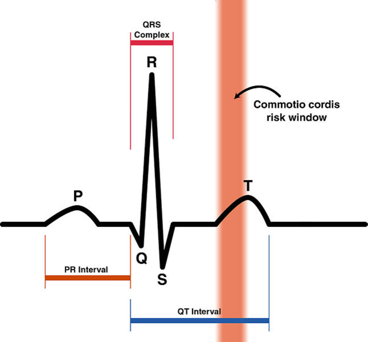 Highlighted in red is the precise moment during the cardiac cycle where interruption of the electrical impulse occurs.